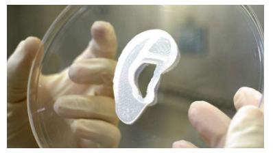 外科医生移植由活细胞制成的3D耳朵