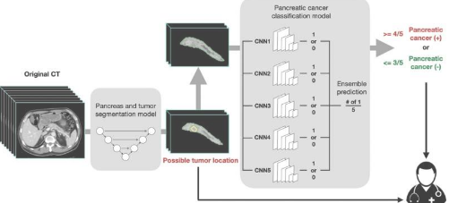 人工智能帮助检测胰腺癌