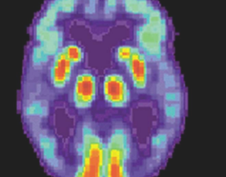 研究人员使用人工智能探索阿尔茨海默病和其他认知障碍的细胞起源
