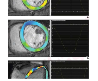 扩张型心肌病患者MRI的心肌应变参数
