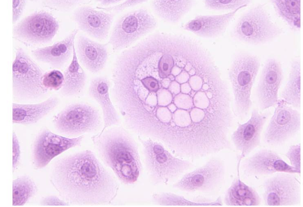 专家提高三阴性乳腺癌潜在治疗靶点的活性
