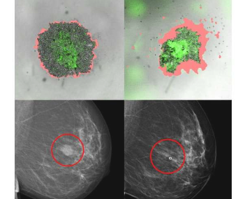 新方法预测乳腺癌患者的正确治疗方法