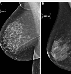 人工智能在预测乳腺癌方面优于标准风险模型