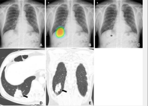 高精度人工智能改善肺癌检测