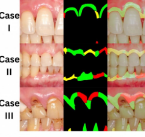大学牙科团队利用人工智能及早发现牙龈炎症
