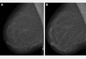 结合人工智能模型改善乳腺癌风险评估