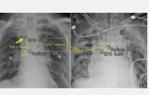 AI在胸部X光检查中确认气管插管位置