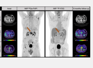 Ga68 FAPI PET改善胰腺癌的检测和分期