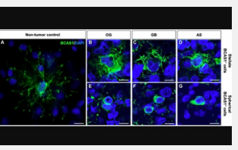 BCAS1定义了弥漫性神经胶质瘤患者的异质细胞群