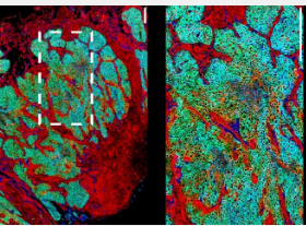 绘制尿路癌细胞的进化图谱