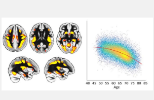 新研究揭示了大脑加速衰老的危险因素